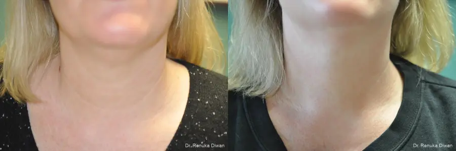 Neck Creases: Patient 5 - Before and After 2