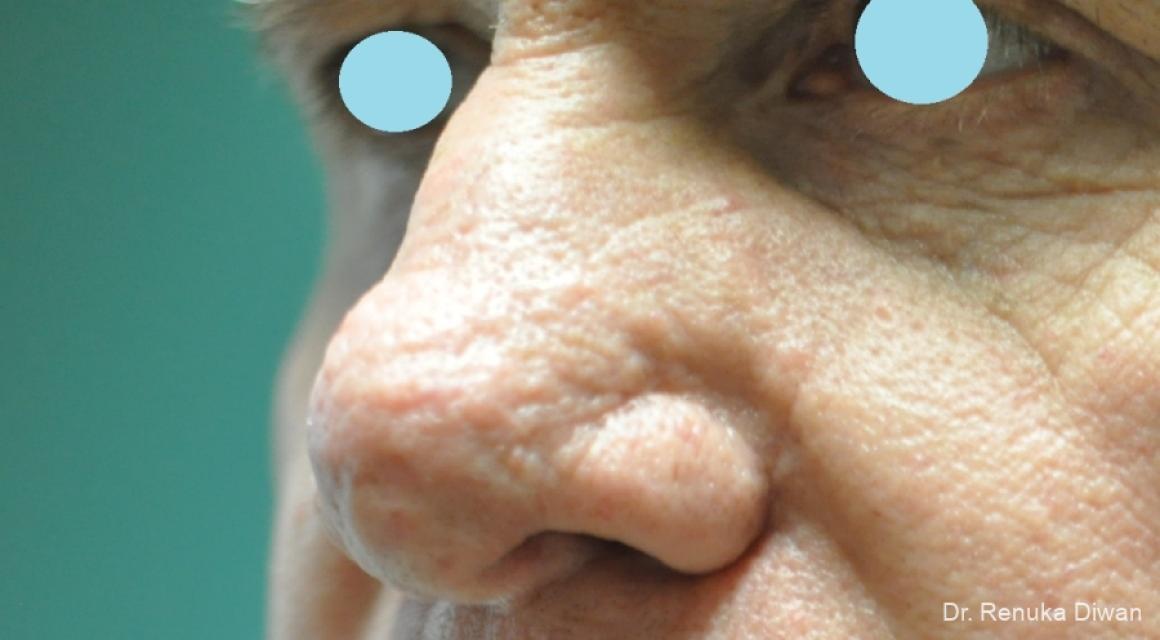 Lasers For Rhinophyma: Patient 5 - Before 3
