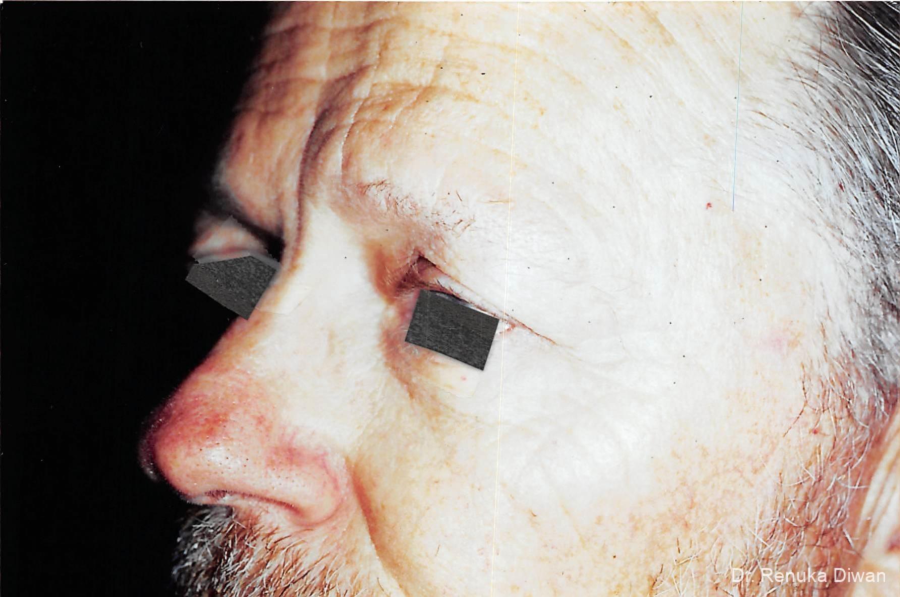 Blepharoplasty For Men: Patient 1 - Before 1