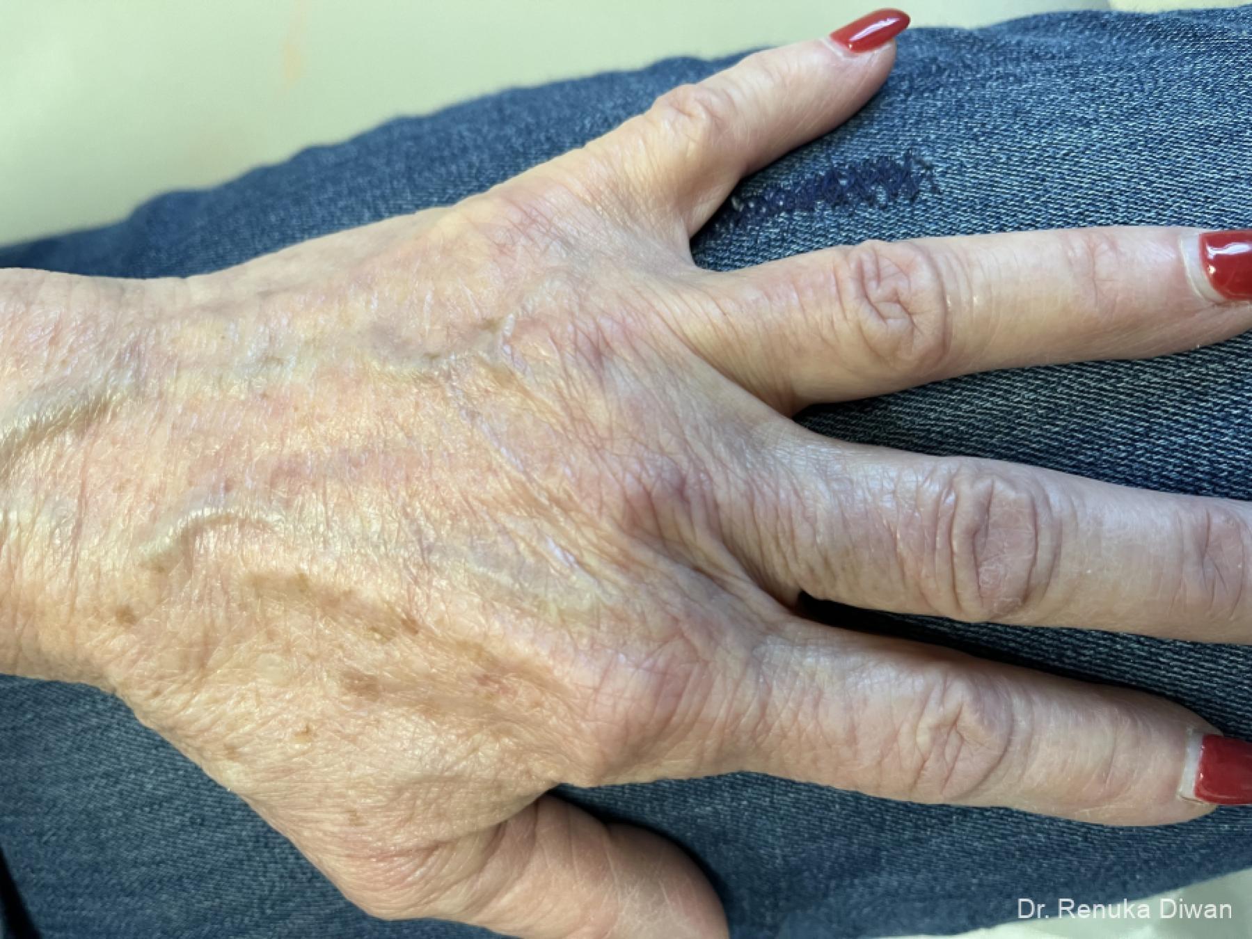 Hand Augmentation: Patient 1 - Before 