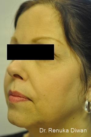 Skin Tightening: Patient 1 - After 1