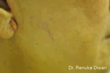 Laser For Veins And Redness: Patient 1 - Before 
