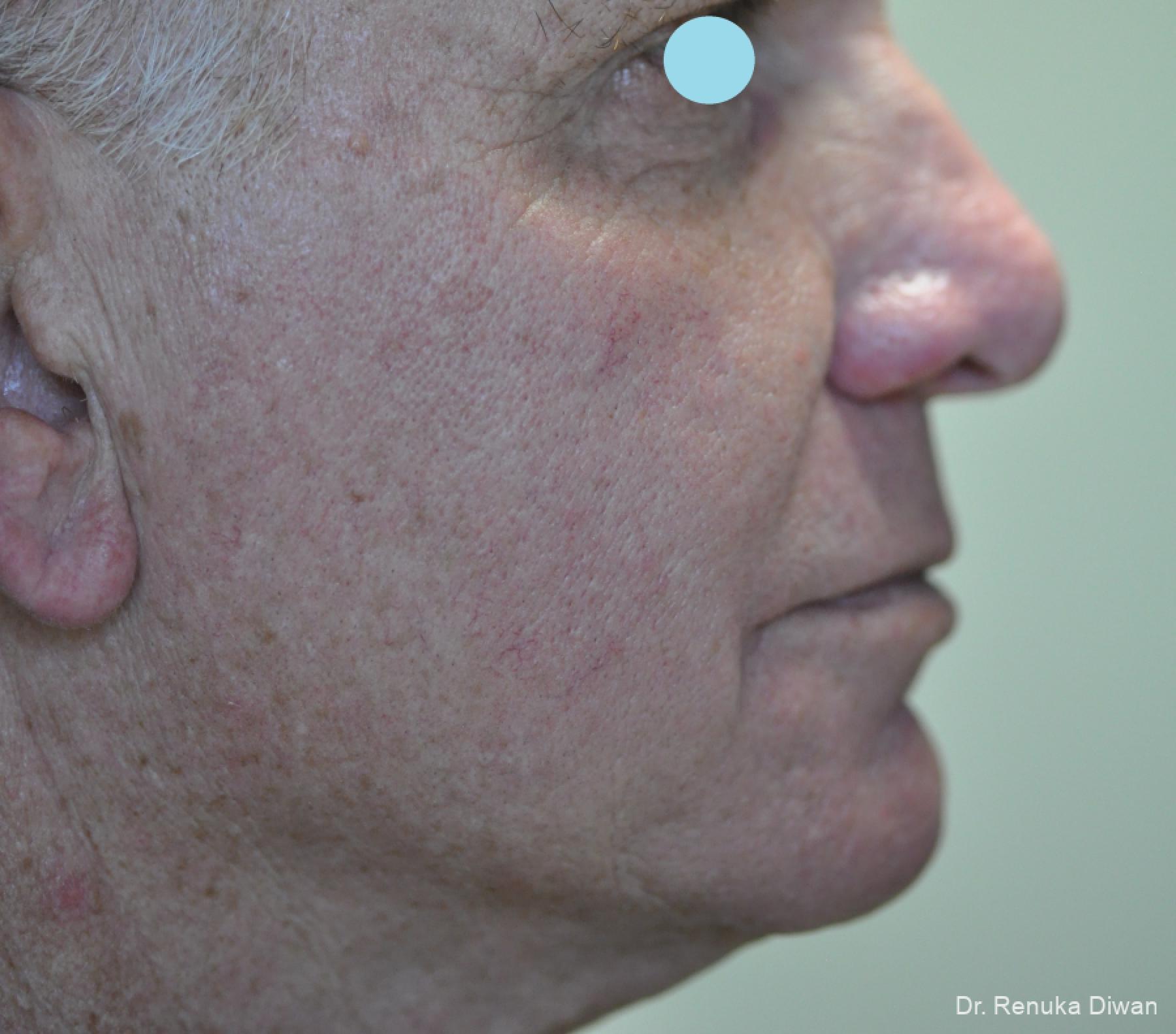 Lasers For Rhinophyma: Patient 5 - After 6