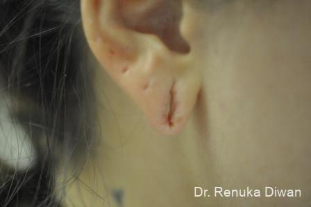 Earlobe Surgery: Patient 6 - Before and After 2