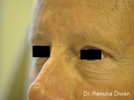 Blepharoplasty For Men: Patient 3 - After 1