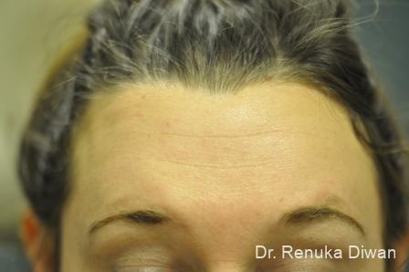 Forehead Creases: Patient 7 - After  
