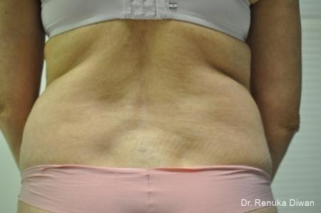 Liposuction: Patient 7 - Before 1
