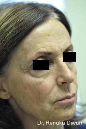 Non-Surgical Facelift: Patient 3 - Before 