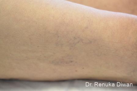 Veins On Legs: Patient 4 - Before 