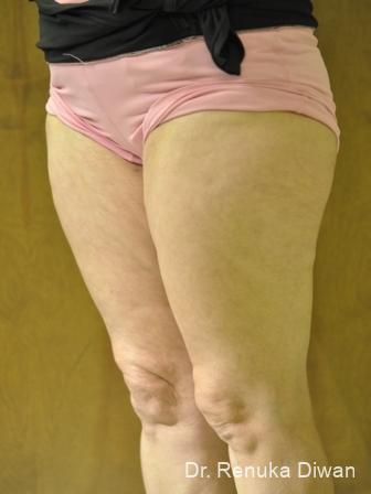 Cellulite Reduction: Patient 1 - After  