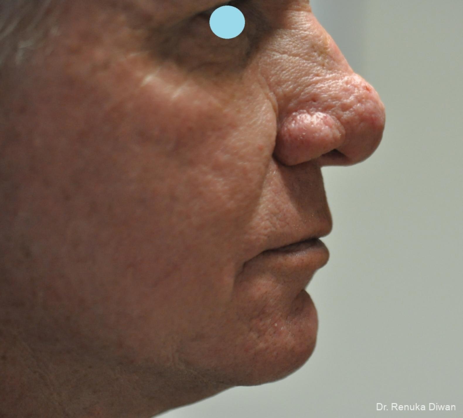 Lasers For Rhinophyma: Patient 5 - Before and After 6