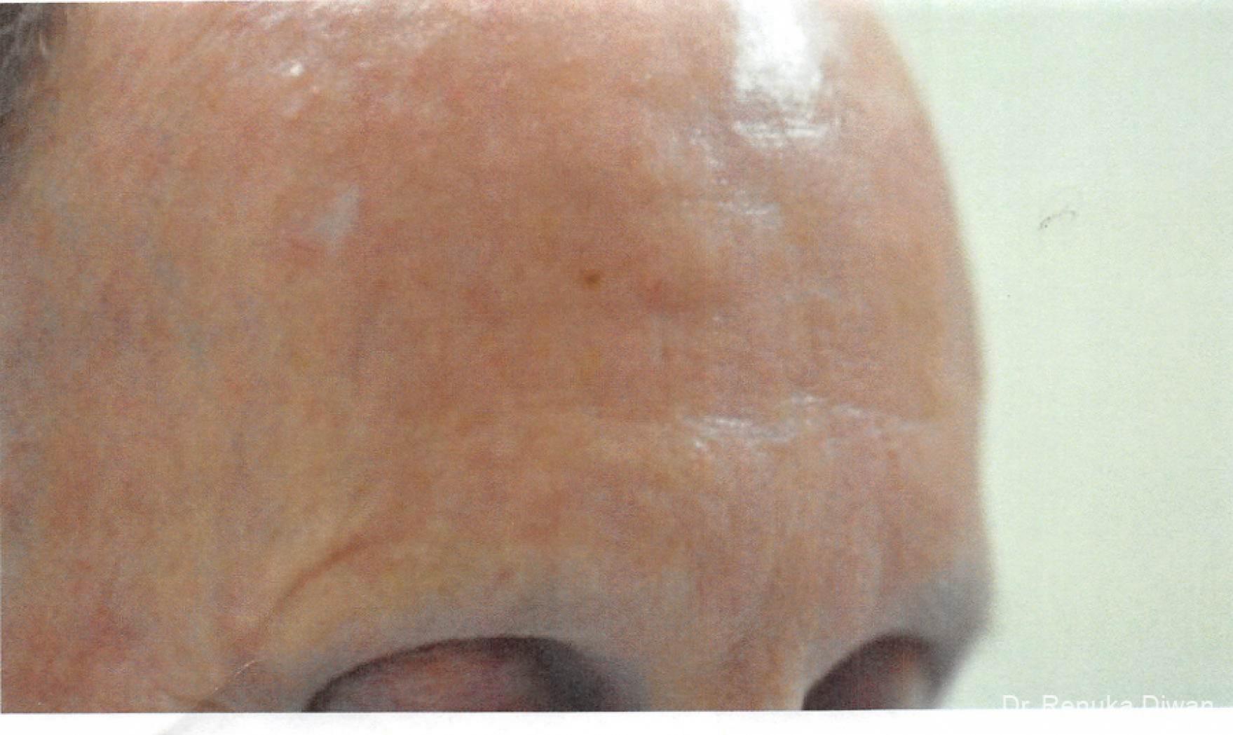 Botox-cosmetic-for-men: Patient 3 - After  