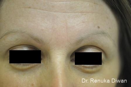 Forehead Creases: Patient 1 - Before 