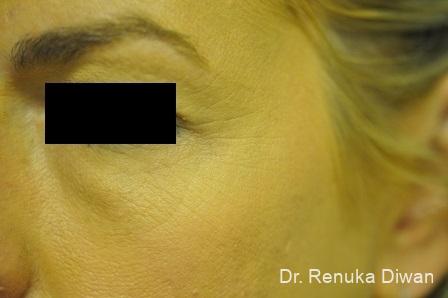 BOTOX® Cosmetic: Patient 23 - Before Image