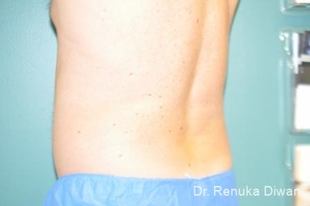 Coolsculpting For Men: Patient 2 - After 1