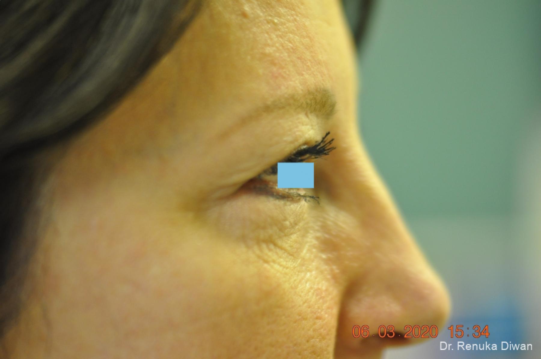 Blepharoplasty: Patient 3 - Before 3