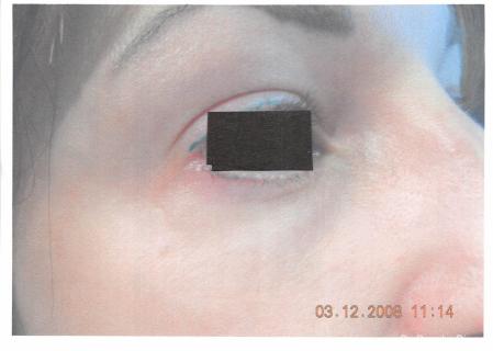 Laser For Veins And Redness: Patient 9 - After  