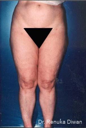Liposuction: Patient 8 - After 1