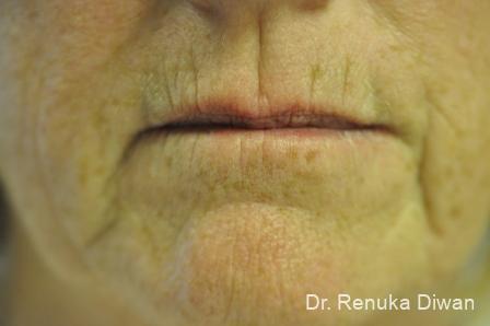 Marionette Lines: Patient 9 - Before 