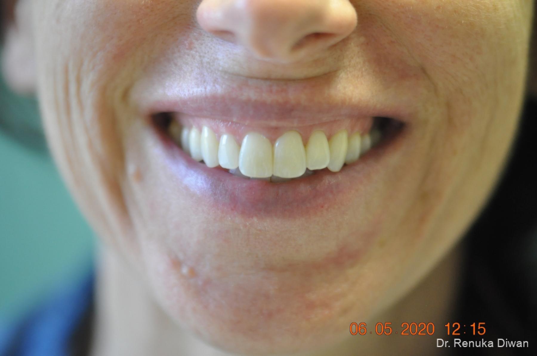 Gummy Smile: Patient 2 - Before 