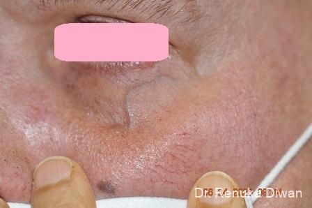 Laser For Veins And Redness: Patient 11 - Before 1