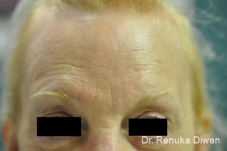 Forehead Creases: Patient 4 - Before 1