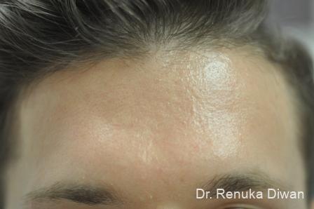 Chemical Peel: Patient 3 - After  