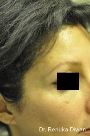 lasers spots brown before patient