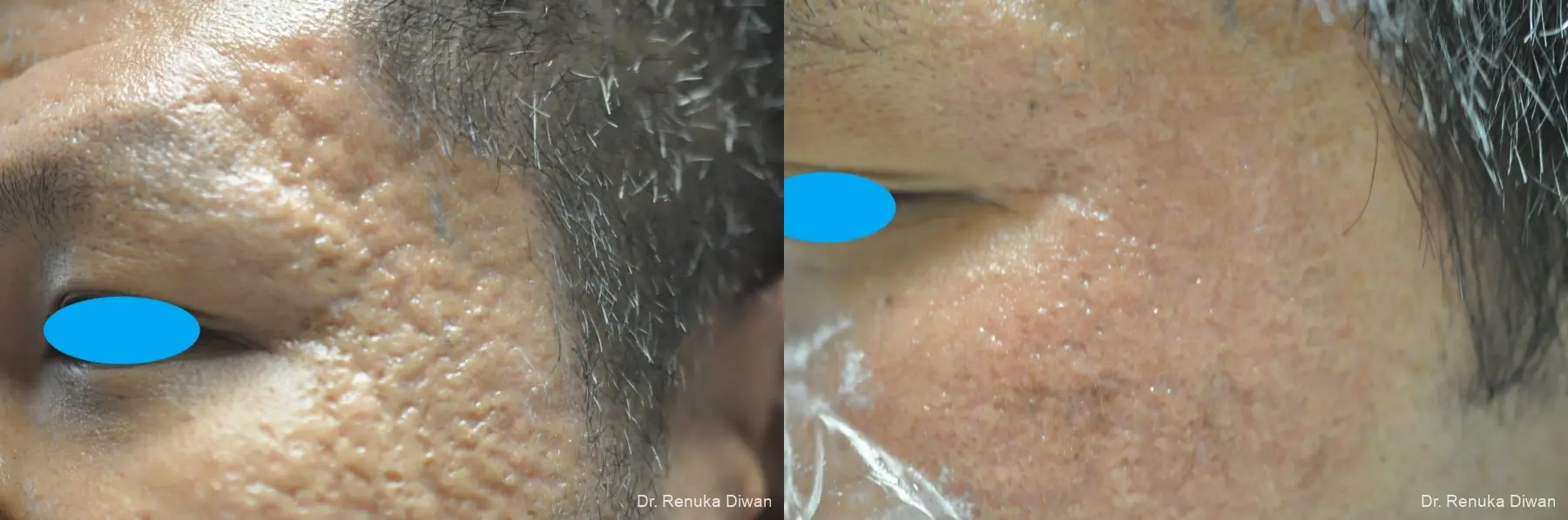 Scars: Patient 1 - Before and After 1