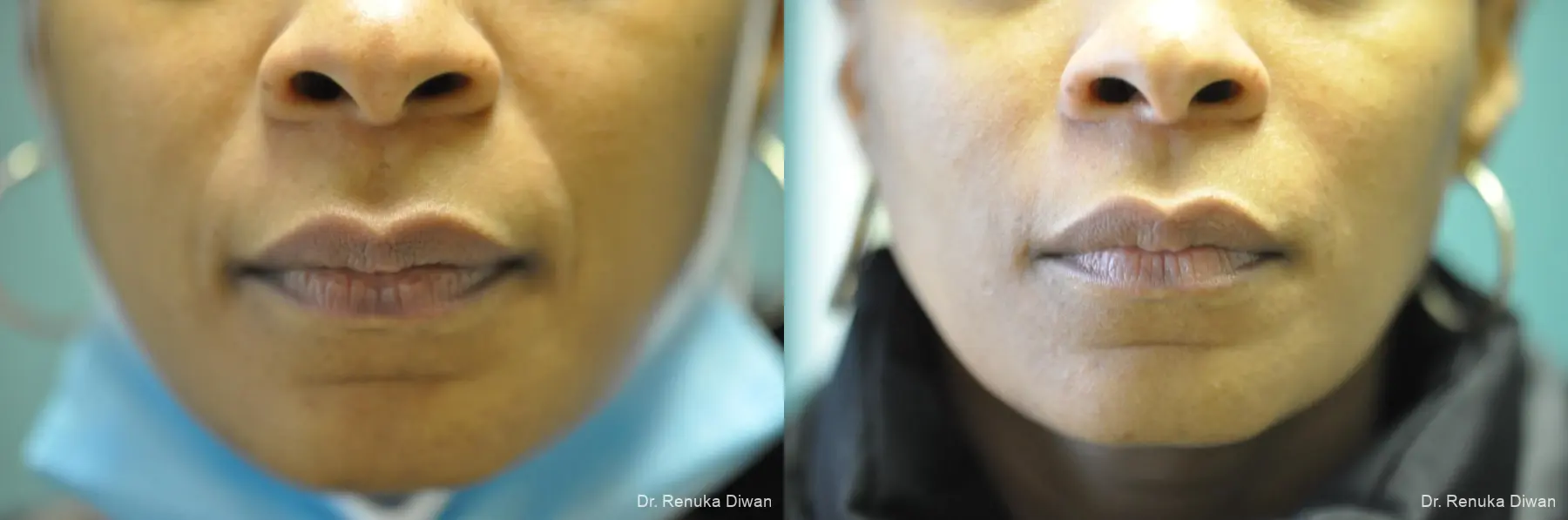 Smile Lines: Patient 12 - Before and After 1