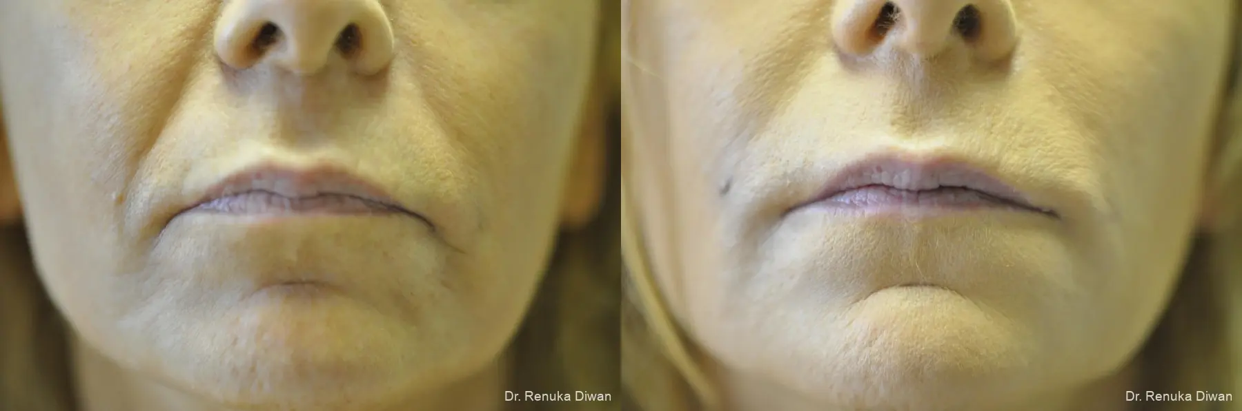 Smile Lines: Patient 11 - Before and After 1