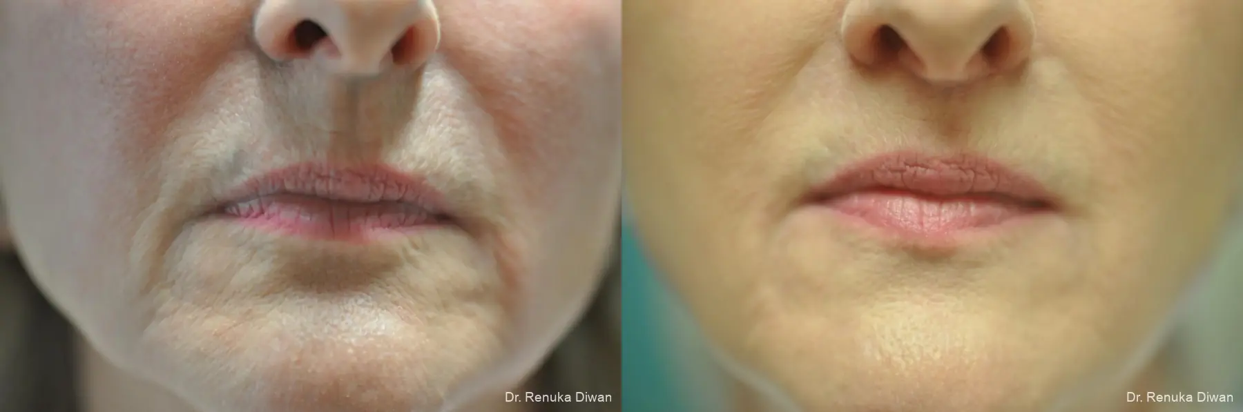 Surgical: Patient 1 - Before and After  