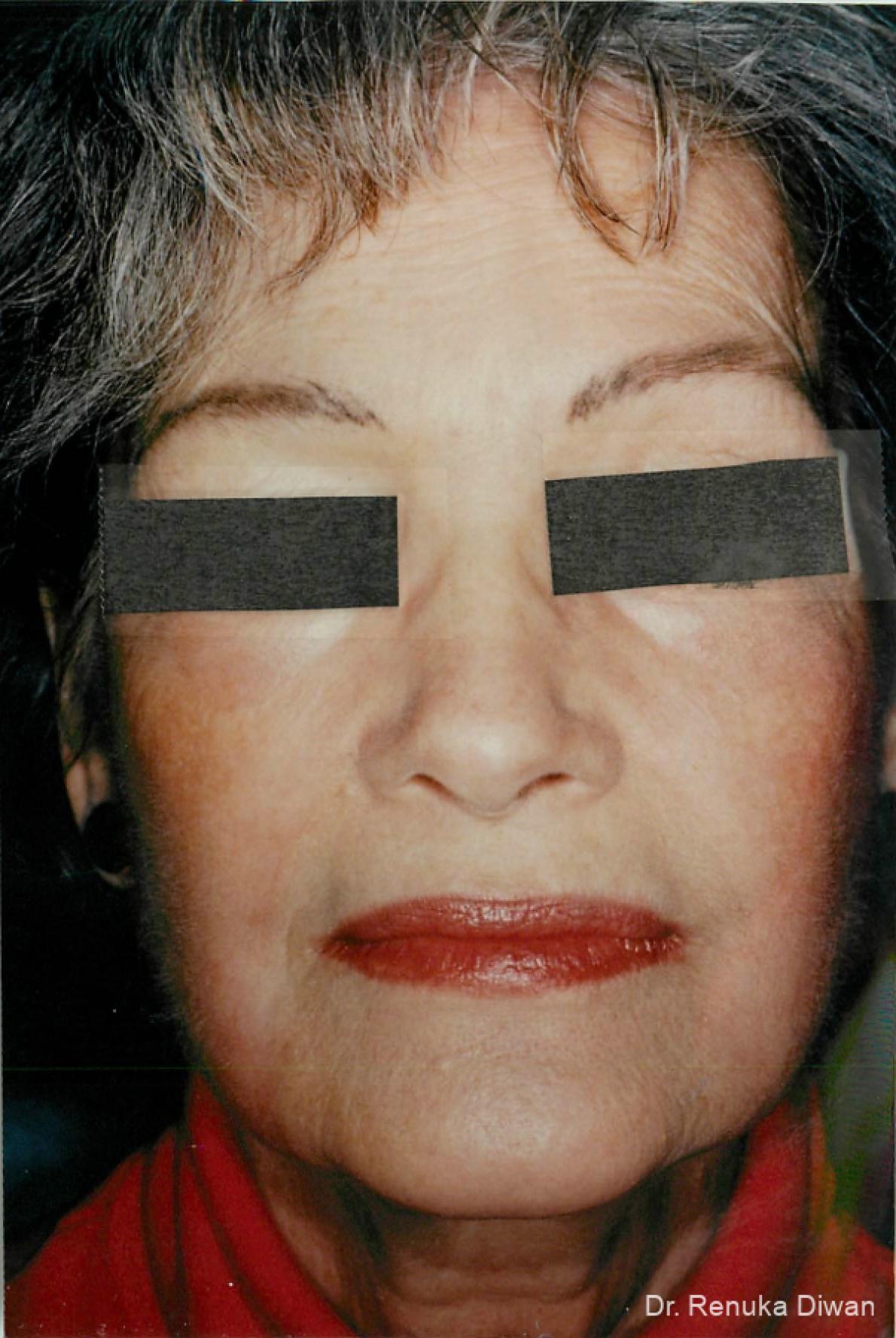 Laser Skin Resurfacing: Patient 5 - After  