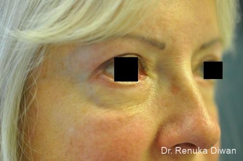 Blepharoplasty: Patient 9 - After  