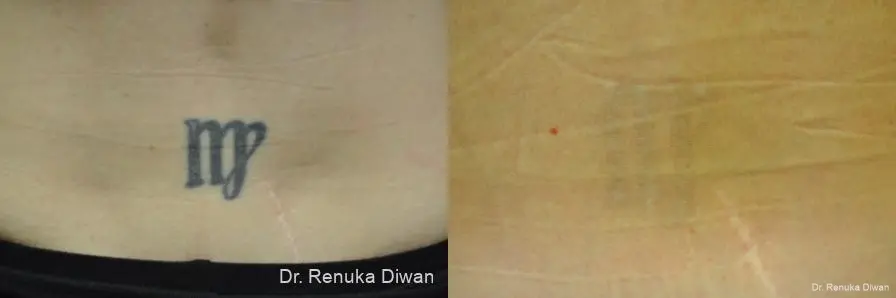 Tattoo Removal: Patient 11 - Before and After  