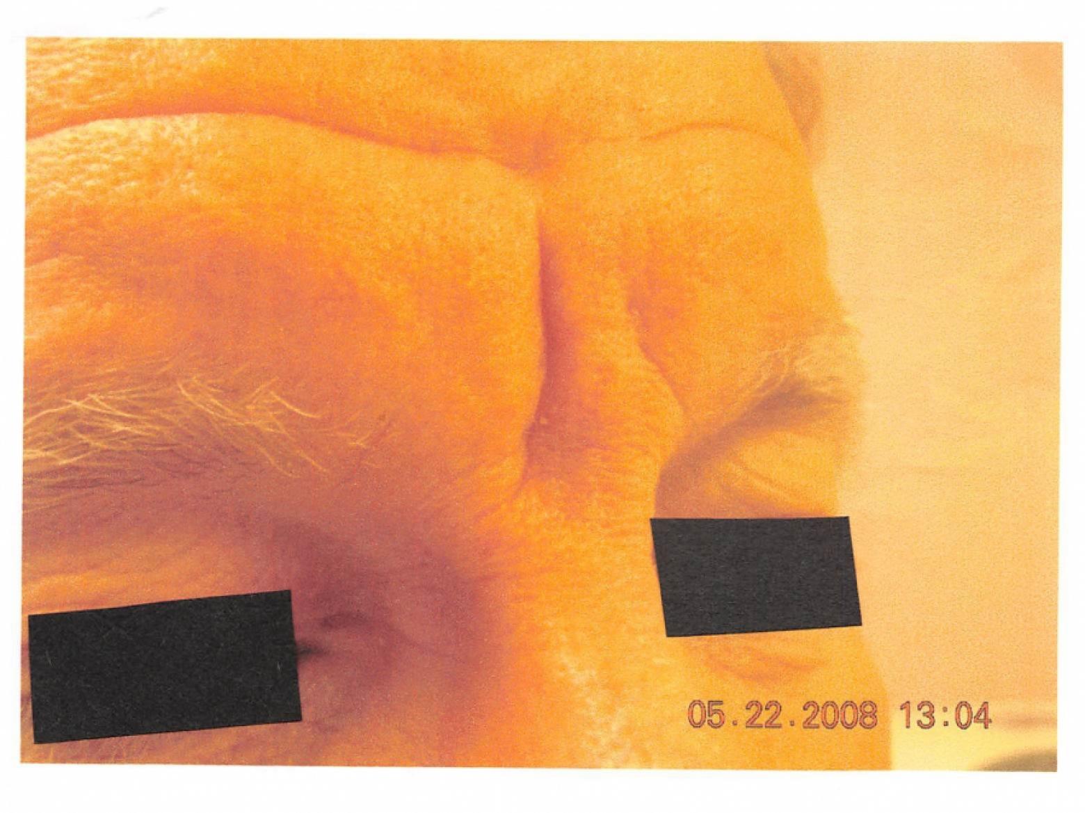 Botox-cosmetic-for-men: Patient 1 - Before 