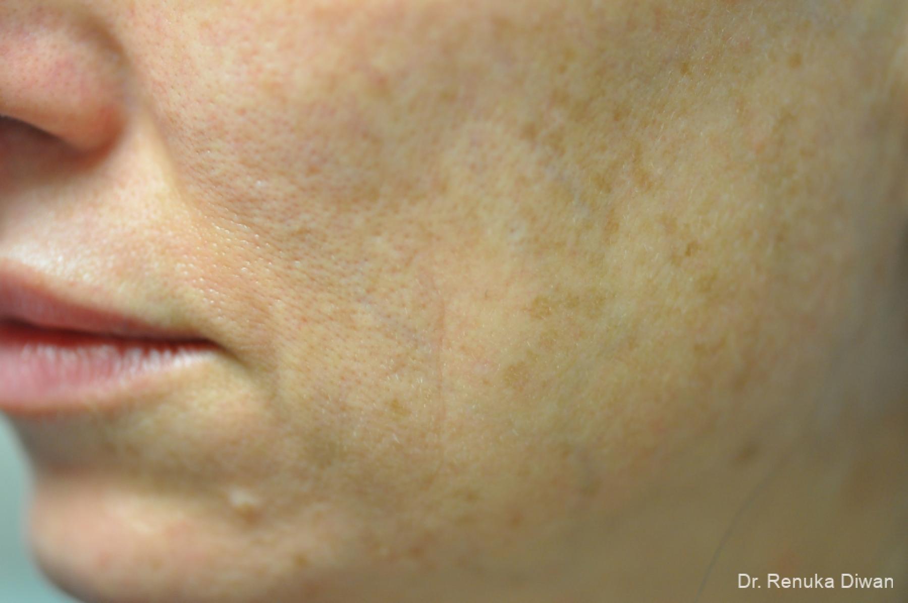 Laser For Veins And Redness: Patient 35 - After 2