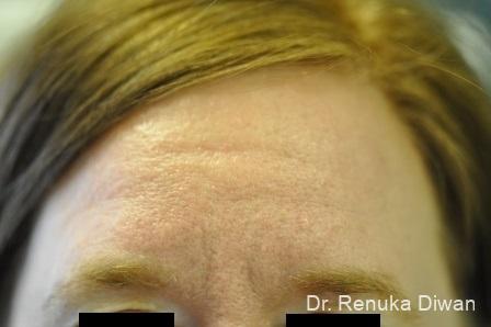 BOTOX® Cosmetic: Patient 5 - Before 