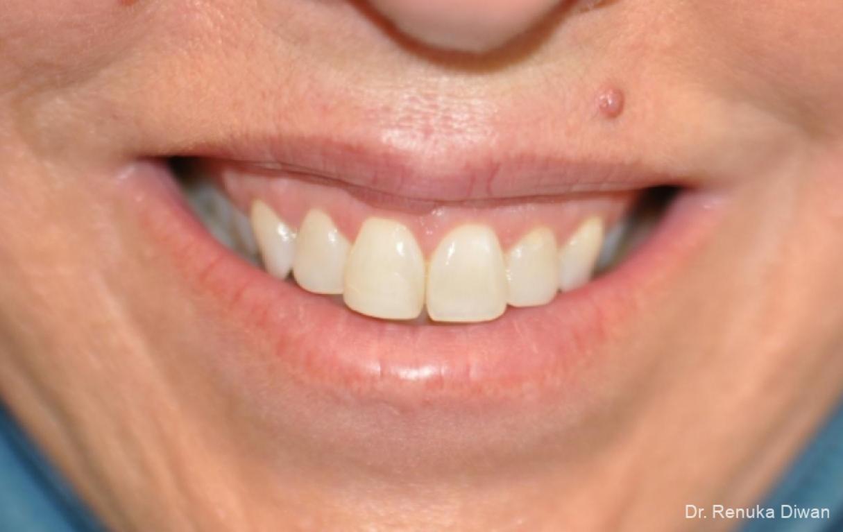 BOTOX® Cosmetic: Patient 30 - Before 1