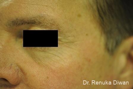 Botox-cosmetic-for-men: Patient 5 - Before 