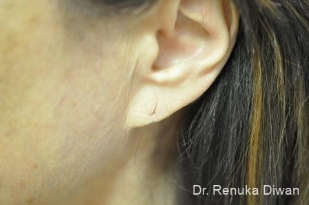 Earlobe Surgery: Patient 3 - Before 