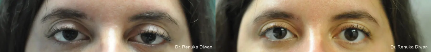Upneeq: Patient 3 - Before and After 1
