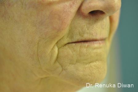 Marionette Lines: Patient 8 - Before 
