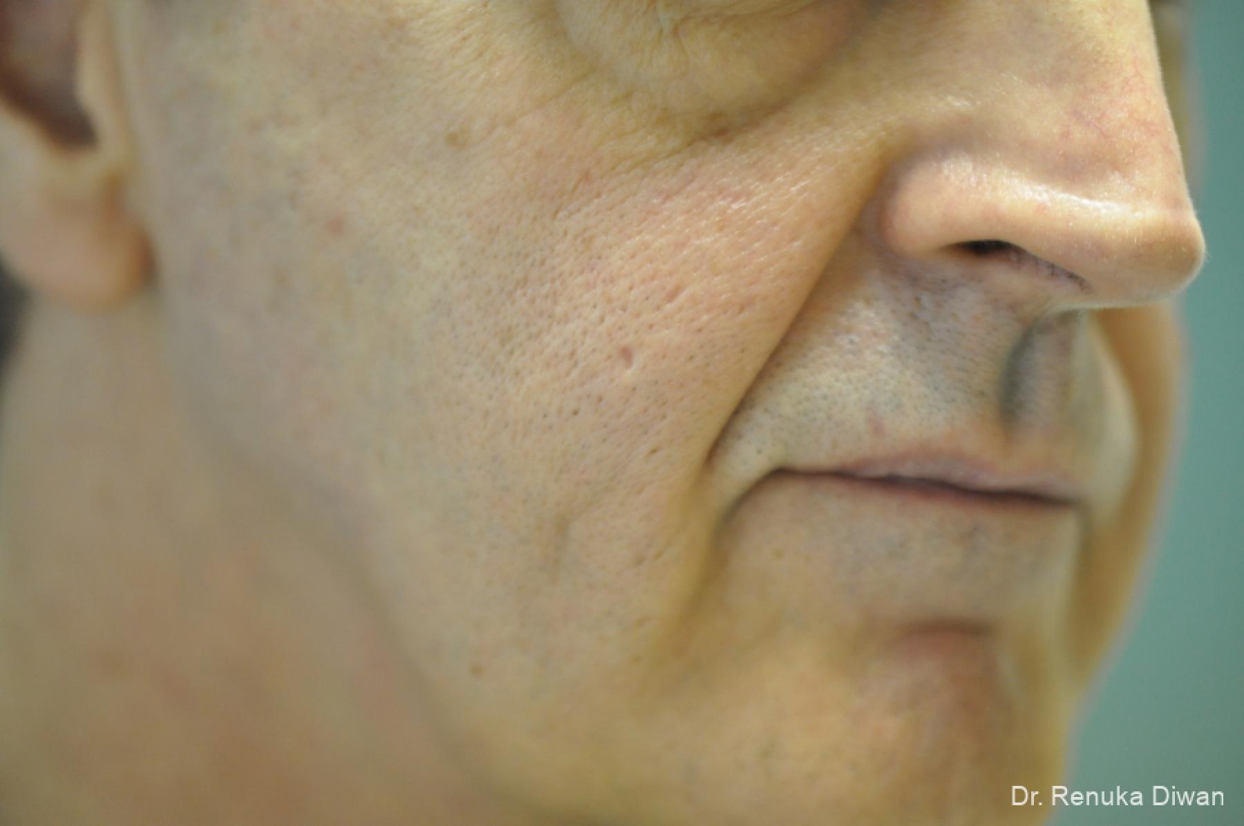 Laser-skin-resurfacing-for-men: Patient 3 - Before 