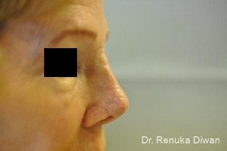 Non-Surgical Rhinoplasty: Patient 1 - After 1
