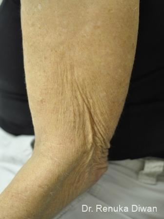 Skin Tightening: Patient 6 - Before 1