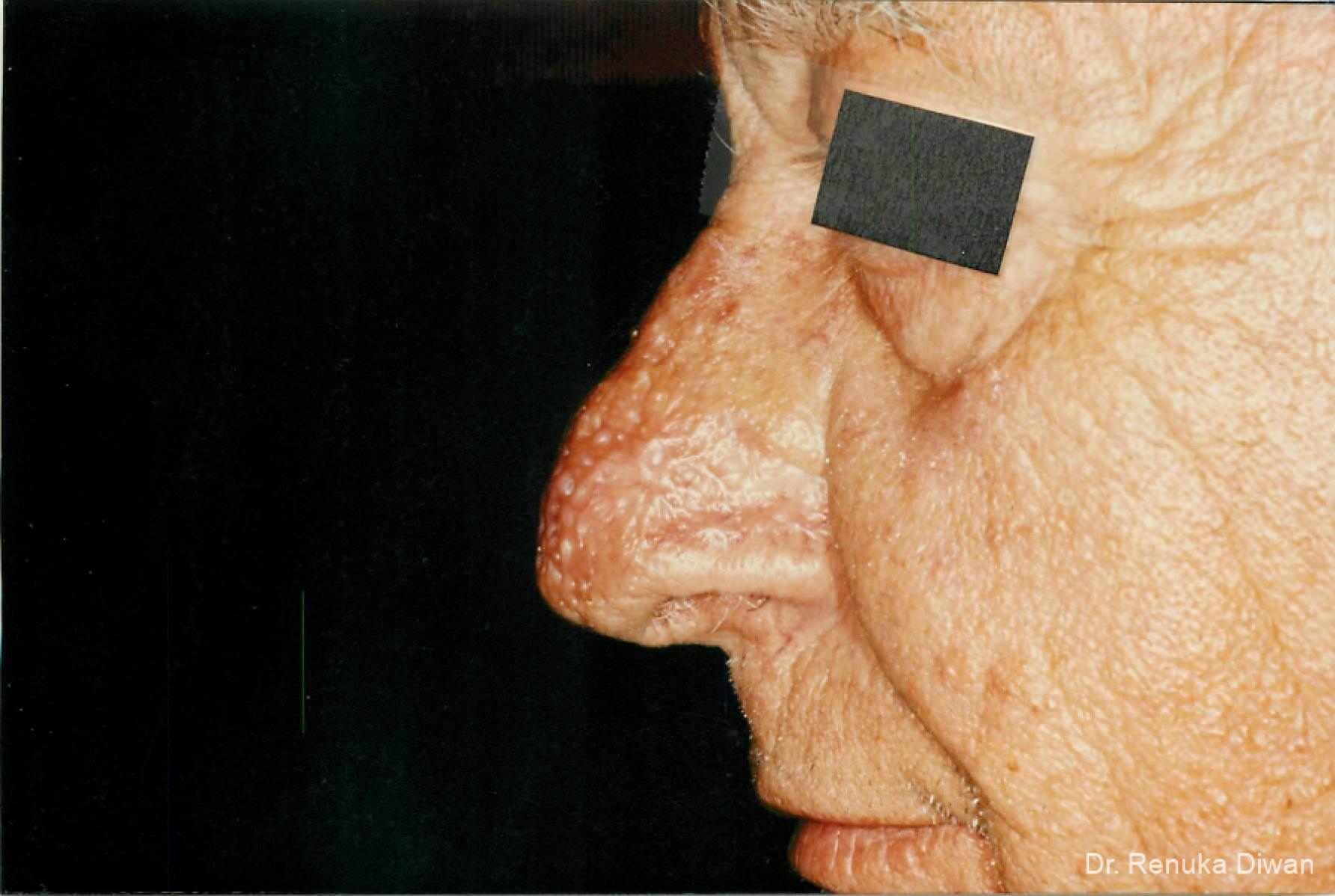 Lasers For Rhinophyma: Patient 2 - After  
