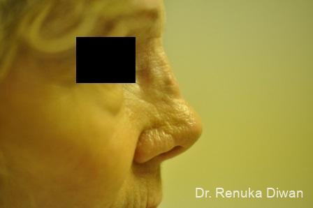 Non-Surgical Rhinoplasty: Patient 1 - Before 