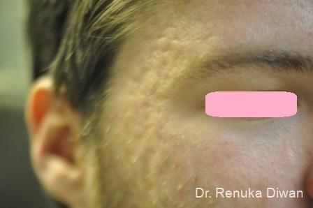 Acne Scars: Patient 4 - Before 