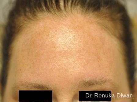 BOTOX® Cosmetic: Patient 11 - After 1